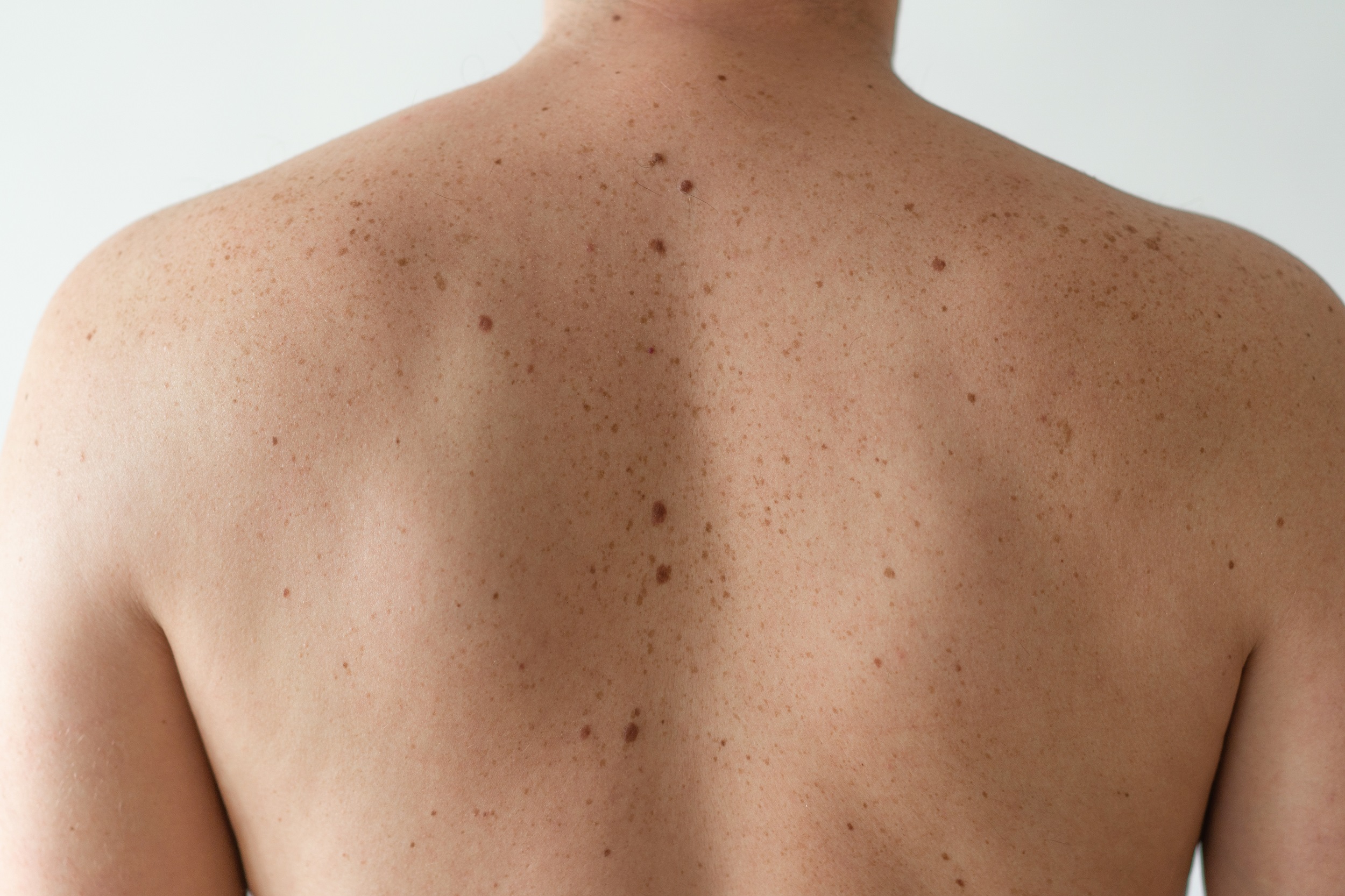 Ways To Get Rid Of Moles On Your Skin